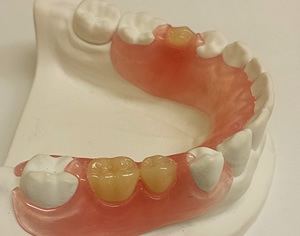 義歯・入れ歯治療とは？