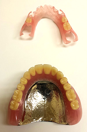 自由診療の入れ歯