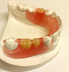 ノンクラスプデンチヤー（金属のない入れ歯）