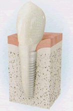 インプラント治療とは？