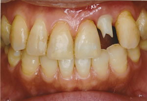 インプラントの土台を入れたところです。