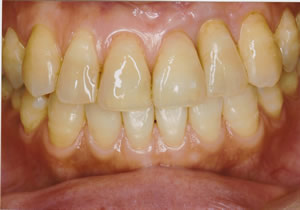 最後に人工歯（セラミック）をインプラントに被せます。