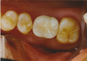 写真はインプラントの治療後になります。