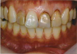 ホワイトニング前