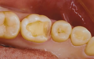 奥歯の治療途中